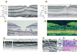 FIGURE 1. Foveal portion of corresponding semithin histological section (A) and in vitro OCT image (B) of a perfusion fixed monkey retina(gc ax: ganglion cell axon layer, gc: ganglion cells, ipl: inner plexiform layer, inl: inner nuclear layer, Hf: fibers of Henle, onl: Outer nuclear layer, cis/cos: cone inner/outer segments, pe: Pigment epithelial layer, ch cap: choriocapillaris, ch: choroid, asterisk: darker faults in foveal floor indicative of foveal strain, d: epi-retinal debris). In vivo optical biopsy using ultrahigh resolution ophthalmic OCT of a patient with macular hole (D) compared with histology (C) of a different post mortem eye with comparable stage of macular hole. (Histology (C) provided by R. Brancato, Italy). Endoscopic ultra-high-resolution OCT tomogram (E, F) versus stained histological cross-section (C) of in vivo mouse colon with distally integrated beamsplitter enables visualization of colonic mucosa (CM), muscular mucosa (MM), submucosa (SM), muscularis externa (ME), and serosa (S) layers. Contrast enhanced portion, using local histogram equalization shows a surface layer of apical crypt cells (AC) as well as vertical structures in the mucosa that may correspond to crypt boundaries (C). FIGURE 1. Foveal portion of corresponding semithin histological section (A) and in vitro OCT image (B) of a perfusion fixed monkey retina(gc ax: ganglion cell axon layer, gc: ganglion cells, ipl: inner plexiform layer, inl: inner nuclear layer, Hf: fibers of Henle, onl: Outer nuclear layer, cis/cos: cone inner/outer segments, pe: Pigment epithelial layer, ch cap: choriocapillaris, ch: choroid, asterisk: darker faults in foveal floor indicative of foveal strain, d: epi-retinal debris). In vivo optical biopsy using ultrahigh resolution ophthalmic OCT of a patient with macular hole (D) compared with histology (C) of a different post mortem eye with comparable stage of macular hole. (Histology (C) provided by R. Brancato, Italy). Endoscopic ultra-high-resolution OCT tomogram (E, F) versus stained histological cross-section (C) of in vivo mouse colon with distally integrated beamsplitter enables visualization of colonic mucosa (CM), muscular mucosa (MM), submucosa (SM), muscularis externa (ME), and serosa (S) layers. Contrast enhanced portion, using local histogram equalization shows a surface layer of apical crypt cells (AC) as well as vertical structures in the mucosa that may correspond to crypt boundaries (C).