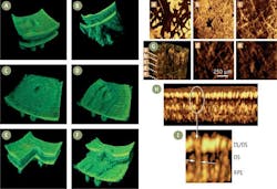 FIGURE 2. Three-dimensional OCT enables unprecedented volumetric representation of pathologic retina at different angled views (A) including from below (B). Virtual biopsy/surgery using OCT (C-F) allows the user to excise and remove any given layer or part of the retinal volume in order to visualize intraretinal morphology. In vivo ultrahigh-resolution OCT of human skin (G): rendering and virtual C-mode scans (a-e) of a pigmented mole (left). The epidermis is much thinner than at the fingertip. Penetration is lower, but highly absorbing structures of about 10 to 30 µm at the basal layer (b, c) and a wide vascular mesh work can be appreciated in the deeper dermal layers (d, e). Toward cellular-resolution retinal imaging: three-dimensional, adaptive optics, ultrahigh-resolution OCT of a small volume of the intraretinal tissue (H, I). The width of single cones (cf. arrows in I) estimated from the images is approximately 4 µm, in agreement with literature. FIGURE 2. Three-dimensional OCT enables unprecedented volumetric representation of pathologic retina at different angled views (A) including from below (B). Virtual biopsy/surgery using OCT (C-F) allows the user to excise and remove any given layer or part of the retinal volume in order to visualize intraretinal morphology. In vivo ultrahigh-resolution OCT of human skin (G): rendering and virtual C-mode scans (a-e) of a pigmented mole (left). The epidermis is much thinner than at the fingertip. Penetration is lower, but highly absorbing structures of about 10 to 30 µm at the basal layer (b, c) and a wide vascular mesh work can be appreciated in the deeper dermal layers (d, e). Toward cellular-resolution retinal imaging: three-dimensional, adaptive optics, ultrahigh-resolution OCT of a small volume of the intraretinal tissue (H, I). The width of single cones (cf. arrows in I) estimated from the images is approximately 4 µm, in agreement with literature.