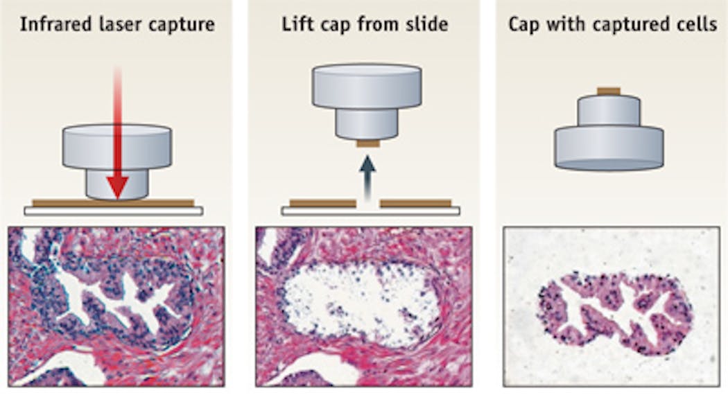 Laser-capture microdissection is an example of a highly successful technology transfer effort involving industry and National Institutes of Health. The original approach uses an infrared laser to activate the EVA polymer placed on top of the target cells (left). The cap with the EVA polymer is removed from the tissue section (center), taking with it the captured cells (right), from which biomolecules can be extracted.