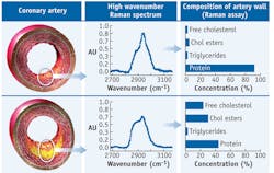 FIGURE 2. Representative Raman spectra measured from coronary artery show a relatively non-atherosclerotic artery location (top row) and a fibroatheroma (bottom row). The spectra can be processed to calculate relative chemical concentrations within the arterial wall, displayed by the bar graphs in the right column. FIGURE 2. Representative Raman spectra measured from coronary artery show a relatively non-atherosclerotic artery location (top row) and a fibroatheroma (bottom row). The spectra can be processed to calculate relative chemical concentrations within the arterial wall, displayed by the bar graphs in the right column.