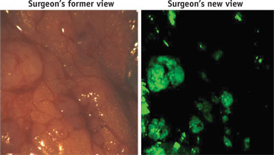 A surgeon&rsquo;s view of ovarian cancer cells with and without the tumor-targeted fluorescent imaging agent.