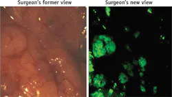 A surgeon’s view of ovarian cancer cells with and without the tumor-targeted fluorescent imaging agent.