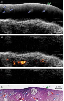 FIGURE 2. A healthy porcine ovary is depicted by (a) OCT (10 × 2.5 mm); (b) US (10 × 5 mm); and (c) PAI superimposed on US (10 × 5 mm); along with (d) the corresponding histology (10 × 2.5 mm). The blue arrow indicates the primordial follicle; the green arrow, the surface epithelium; and the red stealth arrow shows a blood vessel. FIGURE 2. A healthy porcine ovary is depicted by (a) OCT (10 × 2.5 mm); (b) US (10 × 5 mm); and (c) PAI superimposed on US (10 × 5 mm); along with (d) the corresponding histology (10 × 2.5 mm). The blue arrow indicates the primordial follicle; the green arrow, the surface epithelium; and the red stealth arrow shows a blood vessel.