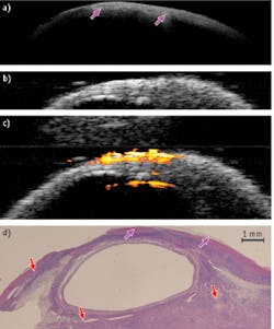 FIGURE 3. (a) OCT (12.5 × 3 mm); (b) US (12.5 × 8 mm); (c) superimposed PAI and US (12.5 × 8 mm); and (d) corresponding histology (12.5 × 5 mm) show ovarian tissue from a patient with endometriosis. The pink arrow shows a collagen bundle; the red stealth arrow points out a blood vessel. FIGURE 3. (a) OCT (12.5 × 3 mm); (b) US (12.5 × 8 mm); (c) superimposed PAI and US (12.5 × 8 mm); and (d) corresponding histology (12.5 × 5 mm) show ovarian tissue from a patient with endometriosis. The pink arrow shows a collagen bundle; the red stealth arrow points out a blood vessel.