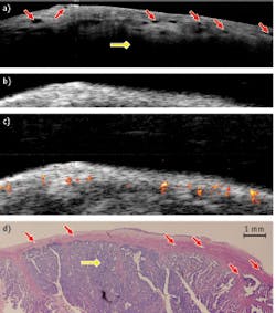 FIGURE 4. Malignant ovarian tissue from a 61-year-old patient is shown through (a) an OCT image (12.5 × 3 mm); (b) a US image (12.5 × 8 mm); and (c) a superimposed PAI and US image (12.5 × 8 mm); plus (d) corresponding histology (12.5 × 4.2 mm). The yellow diamond arrow points to the clearly malignant tissue. FIGURE 4. Malignant ovarian tissue from a 61-year-old patient is shown through (a) an OCT image (12.5 × 3 mm); (b) a US image (12.5 × 8 mm); and (c) a superimposed PAI and US image (12.5 × 8 mm); plus (d) corresponding histology (12.5 × 4.2 mm). The yellow diamond arrow points to the clearly malignant tissue.
