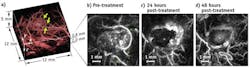 Photoacoustic imaging clearly identifies changes in blood vessels that feed a cancer tumor after administration of a therapeutic vascular disruption agent. The technique penetrates tissue to depths of 10 mm. Photoacoustic imaging clearly identifies changes in blood vessels that feed a cancer tumor after administration of a therapeutic vascular disruption agent. The technique penetrates tissue to depths of 10 mm.