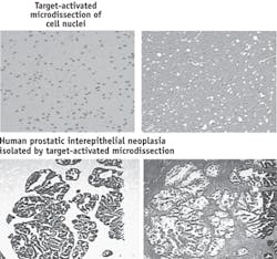 A new, high-throughput, low-cost, laser-capture microdissection technique captures specifically stained targets with light energies 50 times less than the previous LCM technique. Here, LCM captures cell nuclei (top) from human brain cells and epithelial cells from a human prostate (bottom; left and right, respectively). The new method was developed by Robert Bonner—who worked on the original LCM concept—and colleagues at NIH. A new, high-throughput, low-cost, laser-capture microdissection technique captures specifically stained targets with light energies 50 times less than the previous LCM technique. Here, LCM captures cell nuclei (top) from human brain cells and epithelial cells from a human prostate (bottom; left and right, respectively). The new method was developed by Robert Bonner—who worked on the original LCM concept—and colleagues at NIH.