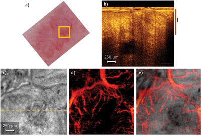 A basal cell carcinoma on a patient's forehead, imaged using (a) dermascopy, with square indicating the optical coherence tomography (OCT) field of view depicted in (b), where black and red bars indicate depth range for (c) and (d), respectively. (c) Intensity en-face mean projection for depth range in (b); dashed line indicates the tomogram position. (d) 2 &times; 2 mm en-face fly through the microvasculature starting from surface. (e) Overlay of microcirculation on structural information.