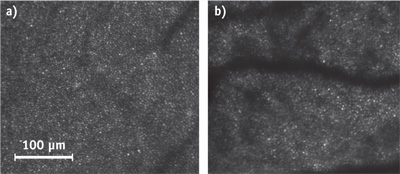 FIGURE 1. An adaptive optics-based retinal-imaging system&mdash;designed by students at the School of Optometry at Indiana University, under the supervision of Ann Elsner and Stephen Burns&mdash;enables quick detection of age-related eye ailments. The system highlights the differences between cone photoreceptors of a healthy 30-year old patient (a) and those of an elderly patient affected by age-related macular degeneration (b), where dark spots indicate regions of damage or inactivity.