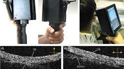FIGURE 1. This handheld device uses optical coherence tomography (OCT) to reveal bacterial biofilms—behind the tympanic membrane (TM)—that cause ear infections. FIGURE 1. This handheld device uses optical coherence tomography (OCT) to reveal bacterial biofilms—behind the tympanic membrane (TM)—that cause ear infections.