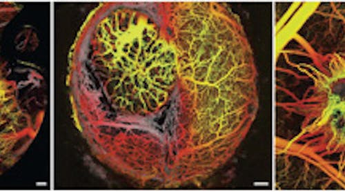 The new imaging tool, which combines multiphoton laser-scanning microscopy (MPLSM) and optical frequency domain imaging (OFDI), reveals strikingly different networks of blood vessels surrounding different types of tumors in a mouse model. Left: Breast cancer in the breast. Middle: Metastatic breast cancer in the brain. Right: Ectopic breast cancer in the skin.