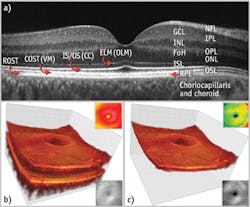 FIGURE 2. A normal human retina,11 imaged using a high-resolution OCT (~4 &mu;m axial resolution) system, is represented in this B-scan slice with each layer identified (a). The B-scan was derived from 3D data sets (b, c). Abbreviations: FoH - fibers of Henle; GCL - ganglion cell layer; INL - inner nuclear layer; IPL - inner plexiform layer; ISL - inner segment layer; NFL - nerve fiber layer; ONL - outer nuclear layer; OPL - outer plexiform layer; OSL - outer segment layer; RPE - retinal pigment epithelium. The outer limiting membrane (OLM; sometimes called external limiting membrane [ELM]), connecting cilia (CC; sometimes called inner/outer segment junction), Verhoeff&apos;s membrane (VM; sometimes called cone photoreceptor outer segment tips [COST]), and rod photoreceptor outer segment tips (ROST) may also be seen.