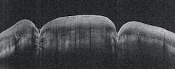 FIGURE 2. Front teeth, imaged in SWIR with Sensors Unlimited's GL2048L camera at 1340 nm as part of Thorlabs' Telesto-II Spectral Domain OCT Imaging System. The image demonstrates 13 μm resolution and 8 mm imaging depth, and shows the bonding of composite caps to the teeth to be tight. FIGURE 2. Front teeth, imaged in SWIR with Sensors Unlimited's GL2048L camera at 1340 nm as part of Thorlabs' Telesto-II Spectral Domain OCT Imaging System. The image demonstrates 13 μm resolution and 8 mm imaging depth, and shows the bonding of composite caps to the teeth to be tight.
