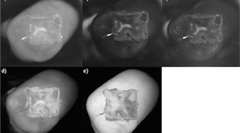 FIGURE 1. Researchers at University of California, San Francisco used Sensors Unlimited&apos;s GA1280J shortwave infrared (SWIR) camera to image the lesions on biting surfaces and between teeth. Occlusal images of one-day lesions for one sample were acquired with different filters: NIR reflectance images with crossed polarizers (a), 1300 nm (b), 1460 nm (c), and 1600 nm, along with visible reflectance image with crossed polarizers (d) and fluorescence (e).