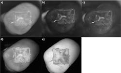 FIGURE 1. Researchers at University of California, San Francisco used Sensors Unlimited's GA1280J shortwave infrared (SWIR) camera to image the lesions on biting surfaces and between teeth. Occlusal images of one-day lesions for one sample were acquired with different filters: NIR reflectance images with crossed polarizers (a), 1300 nm (b), 1460 nm (c), and 1600 nm, along with visible reflectance image with crossed polarizers (d) and fluorescence (e). FIGURE 1. Researchers at University of California, San Francisco used Sensors Unlimited's GA1280J shortwave infrared (SWIR) camera to image the lesions on biting surfaces and between teeth. Occlusal images of one-day lesions for one sample were acquired with different filters: NIR reflectance images with crossed polarizers (a), 1300 nm (b), 1460 nm (c), and 1600 nm, along with visible reflectance image with crossed polarizers (d) and fluorescence (e).