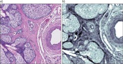 FIGURE 4. Different views of an eyelid tissue section containing a meibomian gland. The visible image (a) is an H&E stained section collected using a white light microscope. The absorbance image (b) is of a neighboring unstained section of the same tissue location fixed to CaF2 disk and was collected by the IR microscope at 1650 cm-1 using the 0.7 NA, 12.5X objective in transmission mode. FIGURE 4. Different views of an eyelid tissue section containing a meibomian gland. The visible image (a) is an H&E stained section collected using a white light microscope. The absorbance image (b) is of a neighboring unstained section of the same tissue location fixed to CaF2 disk and was collected by the IR microscope at 1650 cm-1 using the 0.7 NA, 12.5X objective in transmission mode.
