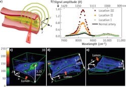 FIGURE 5. Lipid mapping of an atherosclerotic artery by VPA microscopy: Schematic drawing of luminal inspection of an atherosclerotic artery by VPA microscopy (a) and VPA spectra elucidate progressively greater levels of lipid deposition inside an arterial wall at positions I, II, and III compared to a normal artery with no lipid deposition (b). 3D-reconstructed VPA images of a confluent lipid core in an atherosclerotic artery (c), scattered lipid deposition in an arterial wall (d), and mild fatty streaks (e). FIGURE 5. Lipid mapping of an atherosclerotic artery by VPA microscopy: Schematic drawing of luminal inspection of an atherosclerotic artery by VPA microscopy (a) and VPA spectra elucidate progressively greater levels of lipid deposition inside an arterial wall at positions I, II, and III compared to a normal artery with no lipid deposition (b). 3D-reconstructed VPA images of a confluent lipid core in an atherosclerotic artery (c), scattered lipid deposition in an arterial wall (d), and mild fatty streaks (e).