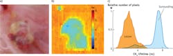 FIGURE 2. (a) A tumor (5 × 5 mm area) is clearly evident in this photo of a hamster cheek. (b) Corresponding FLIm images (emission at 390 nm spectral band) were obtained from the measurements of the area pictured in (a). The tumor/lesion area shows a lower lifetime than the surrounding area because fluorescence emission from NADH dominates there, whereas collagen dominates in the normal epithelium. The axial and lateral pixel sizes for FLIM were 0.1 and 0.2 mm, respectively. (c) Fluorescence lifetime histogram of manually segmented tumor area vs. surrounding area. FIGURE 2. (a) A tumor (5 × 5 mm area) is clearly evident in this photo of a hamster cheek. (b) Corresponding FLIm images (emission at 390 nm spectral band) were obtained from the measurements of the area pictured in (a). The tumor/lesion area shows a lower lifetime than the surrounding area because fluorescence emission from NADH dominates there, whereas collagen dominates in the normal epithelium. The axial and lateral pixel sizes for FLIM were 0.1 and 0.2 mm, respectively. (c) Fluorescence lifetime histogram of manually segmented tumor area vs. surrounding area.