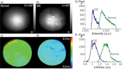 FIGURE 7. Representative intensity images generated in vivo in head and neck cancer patients show (a) normal and (b) tumor tissue; corresponding lifetime images are (c) normal and (d) tumor. Histograms compare (e) intensity and (f) lifetime. Results are for 460 nm emission band (NADH fluorescence). FIGURE 7. Representative intensity images generated in vivo in head and neck cancer patients show (a) normal and (b) tumor tissue; corresponding lifetime images are (c) normal and (d) tumor. Histograms compare (e) intensity and (f) lifetime. Results are for 460 nm emission band (NADH fluorescence).
