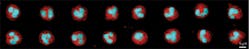 FIGURE 4. Images of height maps of neutrophil cells collected by the optical Coulter counter are shown in red. The nuclear morphology is also simultaneously observed using a nucleic acid fluorescence stain, Syto16, shown in blue. FIGURE 4. Images of height maps of neutrophil cells collected by the optical Coulter counter are shown in red. The nuclear morphology is also simultaneously observed using a nucleic acid fluorescence stain, Syto16, shown in blue.
