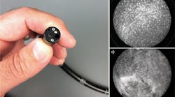 FIGURE 1. This fiber-optic microscope (a) can be inserted into a patient&apos;s esophagus to distinguish healthy (b) from cancerous tissue (c).