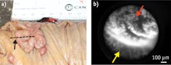 In this cancerous human colon (a), the black arrow points to the transition area between normal and diseased tissue, and the dotted line represents the path imaged with the DRSME (b). In the microendoscopic image of transition area, the yellow arrow points to normal glandular epithelium and the red arrow points to the tumor. In this cancerous human colon (a), the black arrow points to the transition area between normal and diseased tissue, and the dotted line represents the path imaged with the DRSME (b). In the microendoscopic image of transition area, the yellow arrow points to normal glandular epithelium and the red arrow points to the tumor.