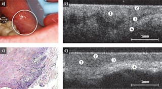 FIGURE 2. Dysplastic buccal mucosa is depicted by photography (a), in-vivo optical coherence tomography (b), and hematoxylin and eosin (H&amp;E stain) at 10x (c). An in-vivo OCT image of normal buccal mucosa (d) enables comparison; in both OCT images, the number 1 indicates stratified squamous epithelium, 2 indicates keratinized epithelial surface layer, 3 points out basement membrane, and 4 shows the submucosa area.