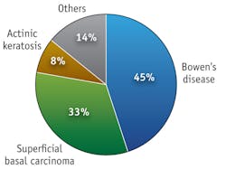 FIGURE 3. Most lesions treated at the Photobiology Unit at the University of Dundee during the past decade correspond to Bowen&apos;s disease (BD) and superficial basal carcinoma; actinic keratosis (AK) lesions and others are in the minority.