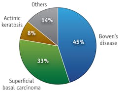 FIGURE 3. Most lesions treated at the Photobiology Unit at the University of Dundee during the past decade correspond to Bowen's disease (BD) and superficial basal carcinoma; actinic keratosis (AK) lesions and others are in the minority. FIGURE 3. Most lesions treated at the Photobiology Unit at the University of Dundee during the past decade correspond to Bowen's disease (BD) and superficial basal carcinoma; actinic keratosis (AK) lesions and others are in the minority.