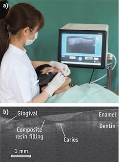 FIGURE 1. A dentist at National Center of Geriatrics (Japan) gets help from cross-polarization in checking the dental health of patient (a), and a cross-section image of a tooth indicates possible caries under the composite resin filling (b). FIGURE 1. A dentist at National Center of Geriatrics (Japan) gets help from cross-polarization in checking the dental health of patient (a), and a cross-section image of a tooth indicates possible caries under the composite resin filling (b).