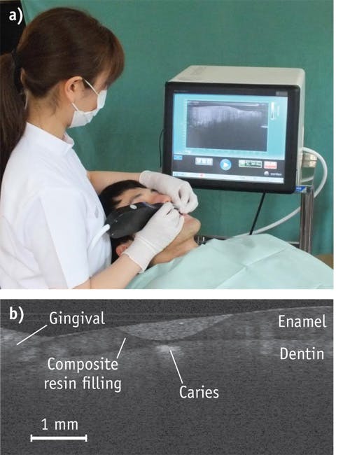 FIGURE 1. A dentist at National Center of Geriatrics (Japan) gets help from cross-polarization in checking the dental health of patient (a), and a cross-section image of a tooth indicates possible caries under the composite resin filling (b).