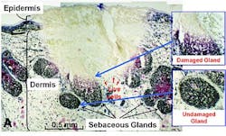 Acne Laser Acne Laser
