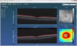 Content Dam Bow En Articles 2014 05 Oct Analysis Software By Voxeleron Leftcolumn Article Thumbnailimage Orion Advanced Optical Coherence Tomography Oct Analysis Software From Voxeleron Content Dam Bow En Articles 2014 05 Oct Analysis Software By Voxeleron Leftcolumn Article Thumbnailimage Orion Advanced Optical Coherence Tomography Oct Analysis Software From Voxeleron