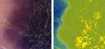 Comparative RGB (left) and hyperspectral (right) images of a melanoma.