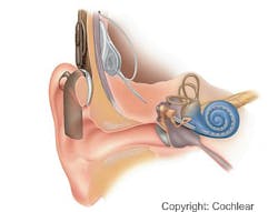 A cochlear implant with an external microphone and micro-speech-processor. A cochlear implant with an external microphone and micro-speech-processor.