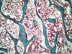 Content Dam Bow Online Articles 2013 08 Bone Biopsy Content Dam Bow Online Articles 2013 08 Bone Biopsy