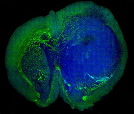 Human glioblastoma brain tumor in the brain of a mouse was made with stimulated Raman scattering (SRS) microscopy, which allows the tumor (blue) to be easily distinguished from normal tissue (green) based on faint signals emitted by tissue with different cellular structures.