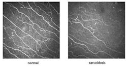Content Dam Bow Online Articles 2013 10 Sarcoidosis Left Content Dam Bow Online Articles 2013 10 Sarcoidosis Left