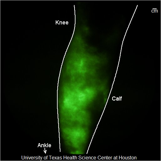 Content Dam Bow Online Articles 2014 06 Leg Lymphedema 2