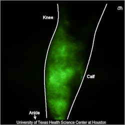 Content Dam Bow Online Articles 2014 06 Leg Lymphedema 2 Content Dam Bow Online Articles 2014 06 Leg Lymphedema 2