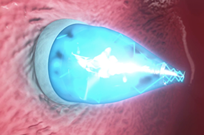 Content Dam Bow Online Articles 2015 October Uv Light Catheter 400x265