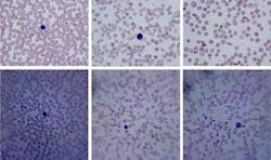 Images from an iPhone microscope are compared to those from a traditional microscope. The upper row shows images of blood samples taken with a traditional microscope. From left to right: normal, iron deficiency anemia, and sickle cell anemia. The bottom row shows the same samples imaged on a smartphone.