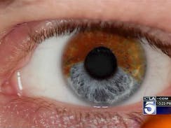 A laser procedure turns brown eyes to blue