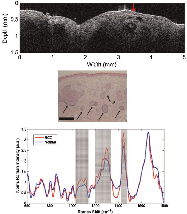 A combined Raman spectroscopy and OCT probe can screen for skin cancer
