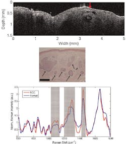 A combined Raman spectroscopy and OCT probe can screen for skin cancer A combined Raman spectroscopy and OCT probe can screen for skin cancer