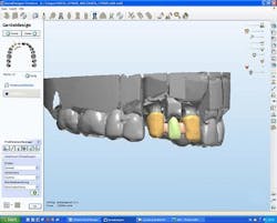 DentalDesigner software shows the makeup of a laser-fused denture design DentalDesigner software shows the makeup of a laser-fused denture design