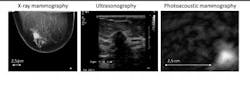 These are (rather small versions of) diagnostic images of a mixed infiltrating lobular and ductal carcinoma in the right breast of a 57 year old patient. The cranio-caudal x-ray mammogram (left) showed an architectural distortion of about 22 mm in the lateral part of the right breast. Ultrasonography (middle) showed the presence of an unsharply edged hypoechoic lesion with a hyperechoic border at the expected location. Photoacoustic mammography (right) showed a confined high-contrast abnormality with a contrast in excess of five and a maximum diameter of 14 mm at the expected lesion depth. Here, a transversal cross-section through this abnormality is visualized. These are (rather small versions of) diagnostic images of a mixed infiltrating lobular and ductal carcinoma in the right breast of a 57 year old patient. The cranio-caudal x-ray mammogram (left) showed an architectural distortion of about 22 mm in the lateral part of the right breast. Ultrasonography (middle) showed the presence of an unsharply edged hypoechoic lesion with a hyperechoic border at the expected location. Photoacoustic mammography (right) showed a confined high-contrast abnormality with a contrast in excess of five and a maximum diameter of 14 mm at the expected lesion depth. Here, a transversal cross-section through this abnormality is visualized.