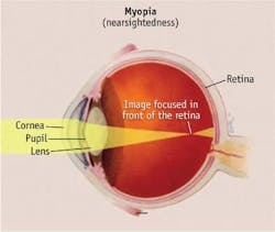 A figure shows myopia (nearsightedness) in the human eye&mdash;a condition that could be prevented or slowed due to new contact lenses in development.