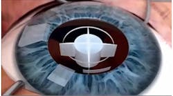 Laser incisions are shown for capsulotomy, followed by laser cuts to fragment the lens prior to aspiration in a typical cataract procedure using femtosecond fiber-based lasers. Laser incisions are shown for capsulotomy, followed by laser cuts to fragment the lens prior to aspiration in a typical cataract procedure using femtosecond fiber-based lasers.