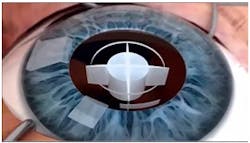 Laser incisions are shown for capsulotomy, followed by laser cuts to fragment the lens prior to aspiration in a typical cataract procedure using femtosecond fiber-based lasers. Laser incisions are shown for capsulotomy, followed by laser cuts to fragment the lens prior to aspiration in a typical cataract procedure using femtosecond fiber-based lasers.